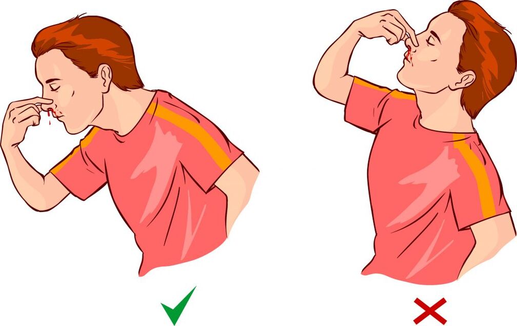 Epistaxis for hypertension