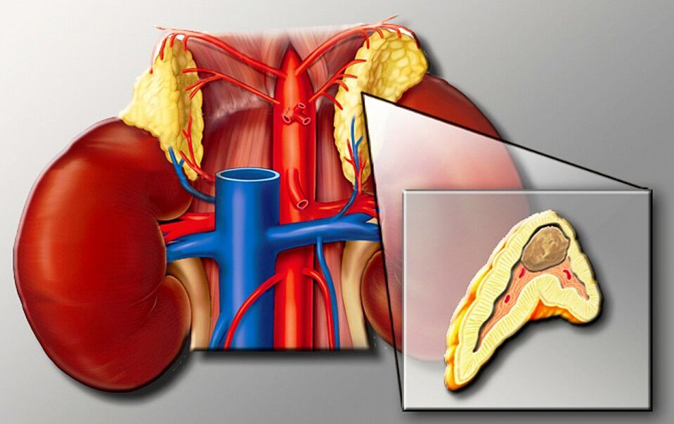 Pyochromocytoma due to hypertension