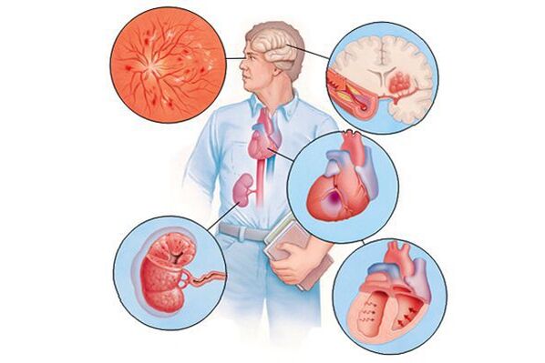 Damage to various organs during long-term high blood pressure.